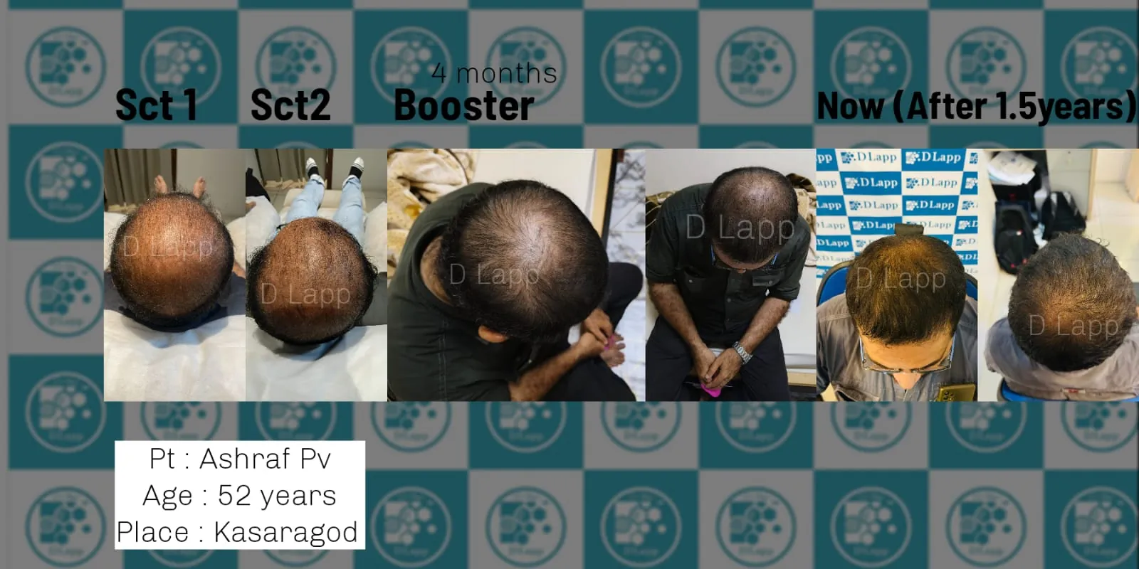 CLINICAL CASE STUDY: Non Surgical hair restoration via stasm cell activation and nbuvb therapy