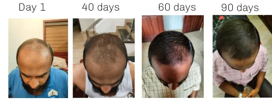 Advanced Non-Transplant Hair Regeneration Restored Density in 90 Days