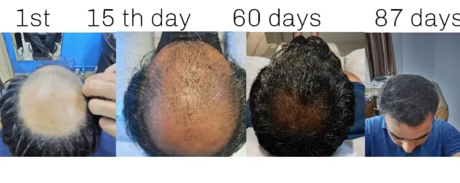 From Grade 7 Baldness to Full Hair Coverage in 87 Days (Non-Surgical Case Study)