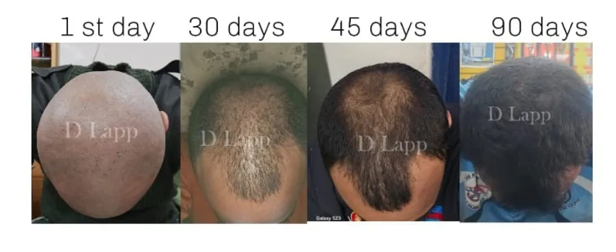 Severe Hair Loss to Full Coverage: Real 90-Day Transformation