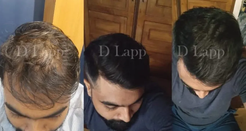 Early Intervention Reversed Advanced Hair Loss in 90 Days (Grade 6–7 Case Study)