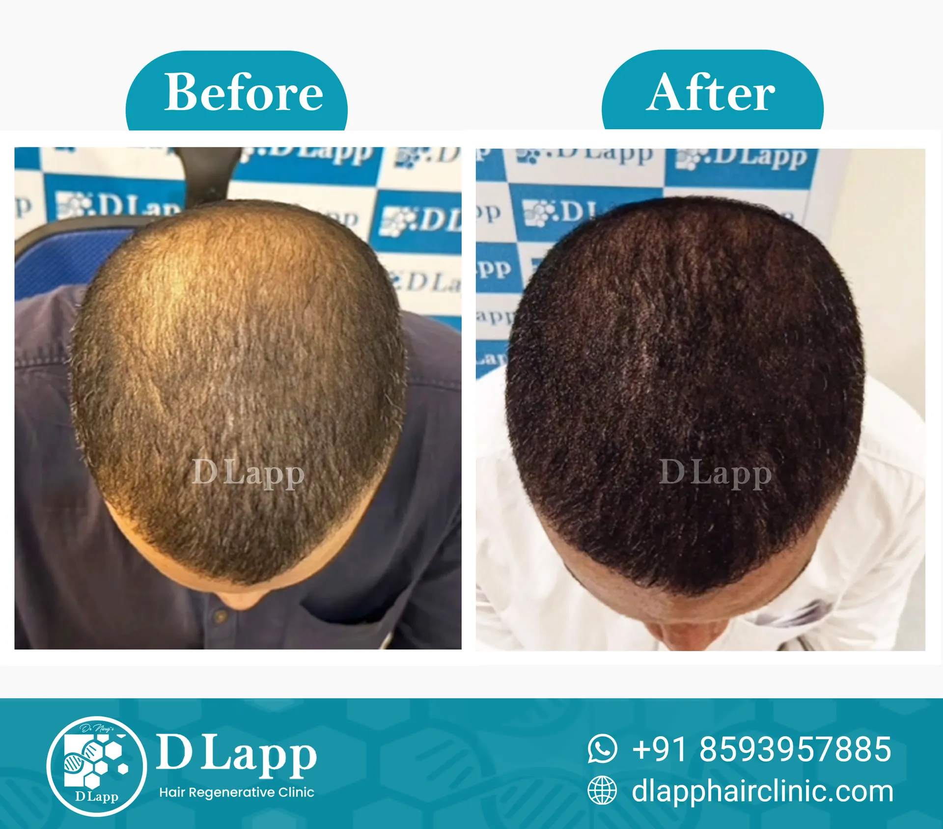 Hair Stem Cell Activation