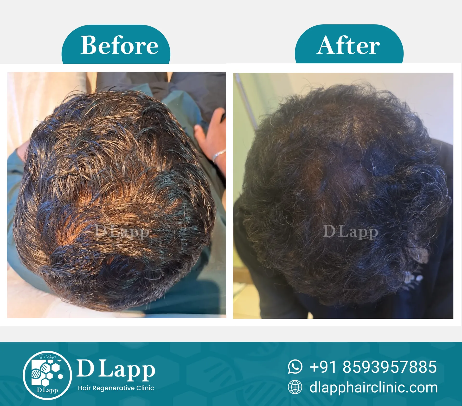 Hair Stem Cell Activation