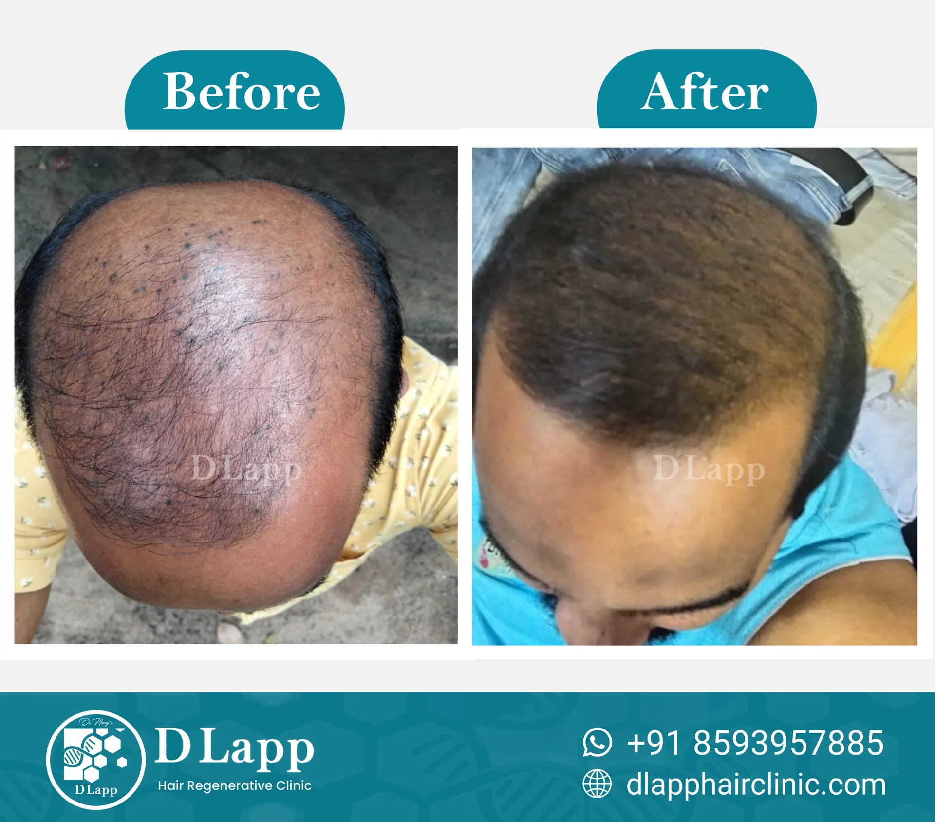Hair Stem Cell Activation