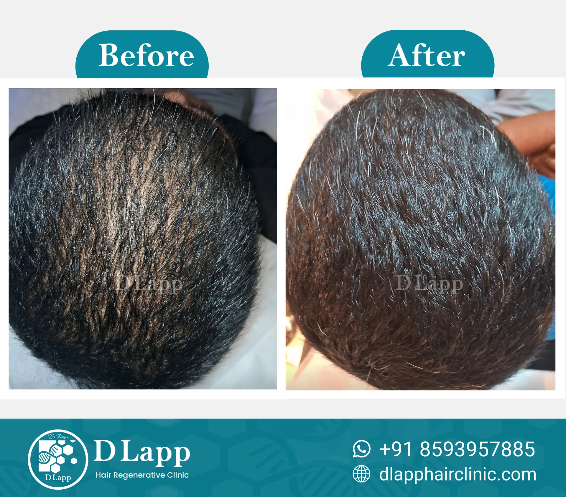 Hair Stem Cell Activation