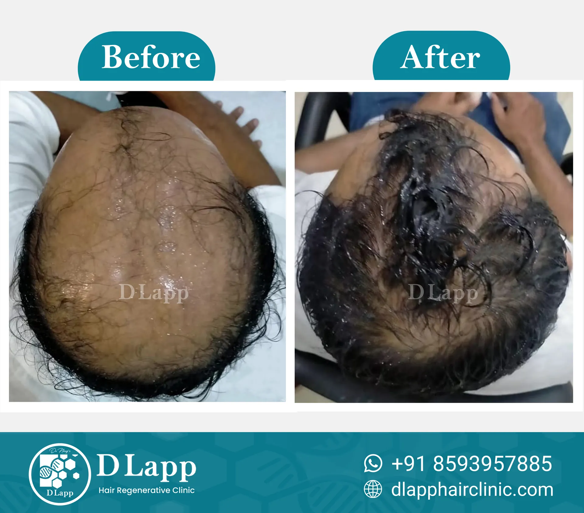 Hair Stem Cell Activation