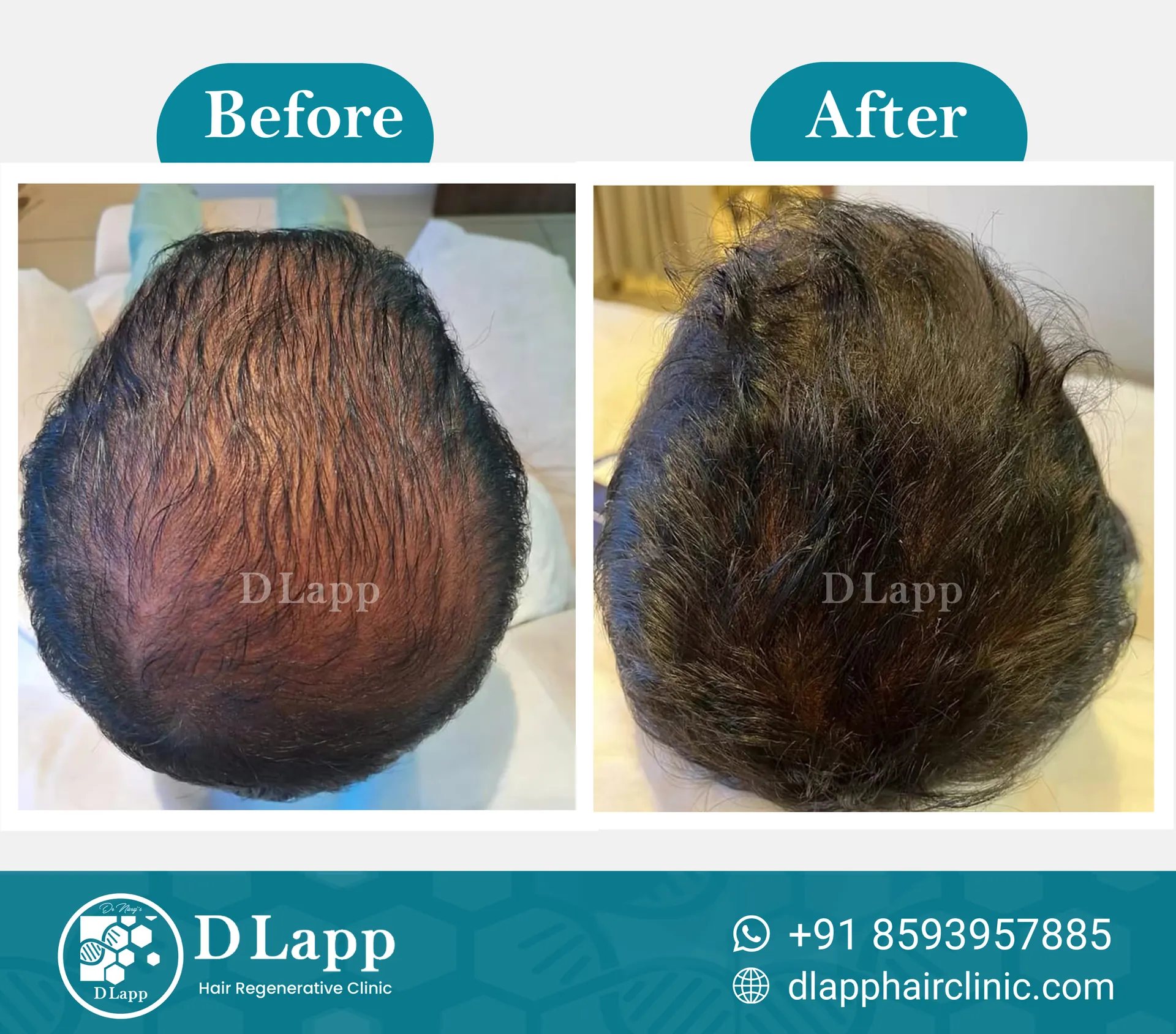 Hair Stem Cell Activation