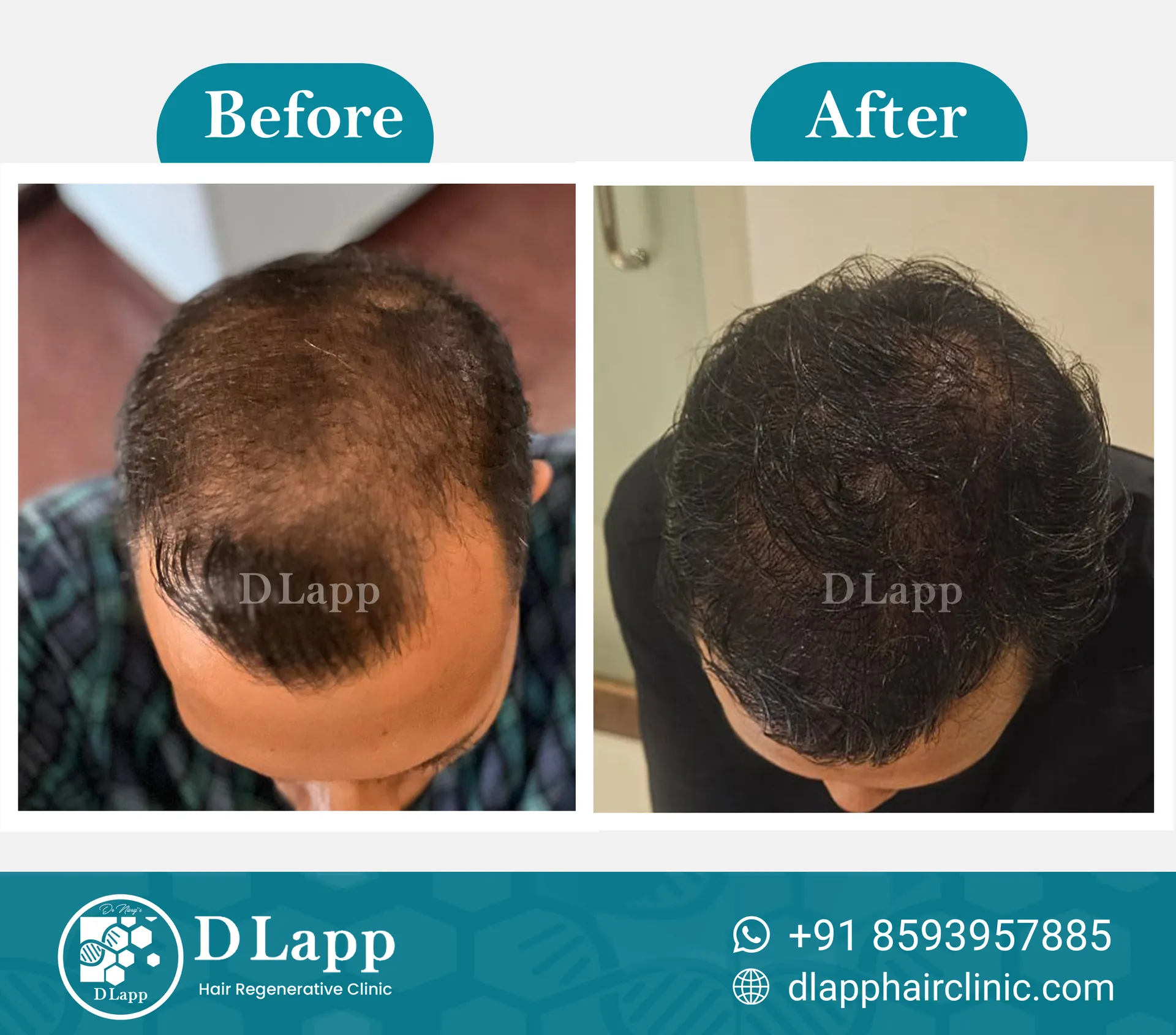 Hair Stem Cell Activation