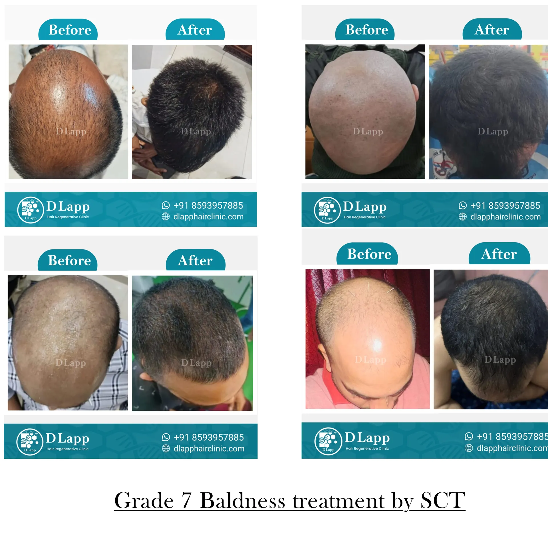 Hair Stem Cell Activation