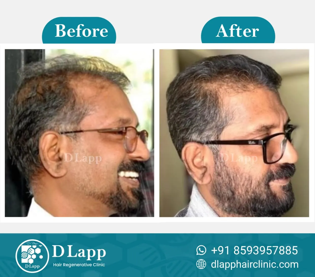 Hair Stem Cell Activation