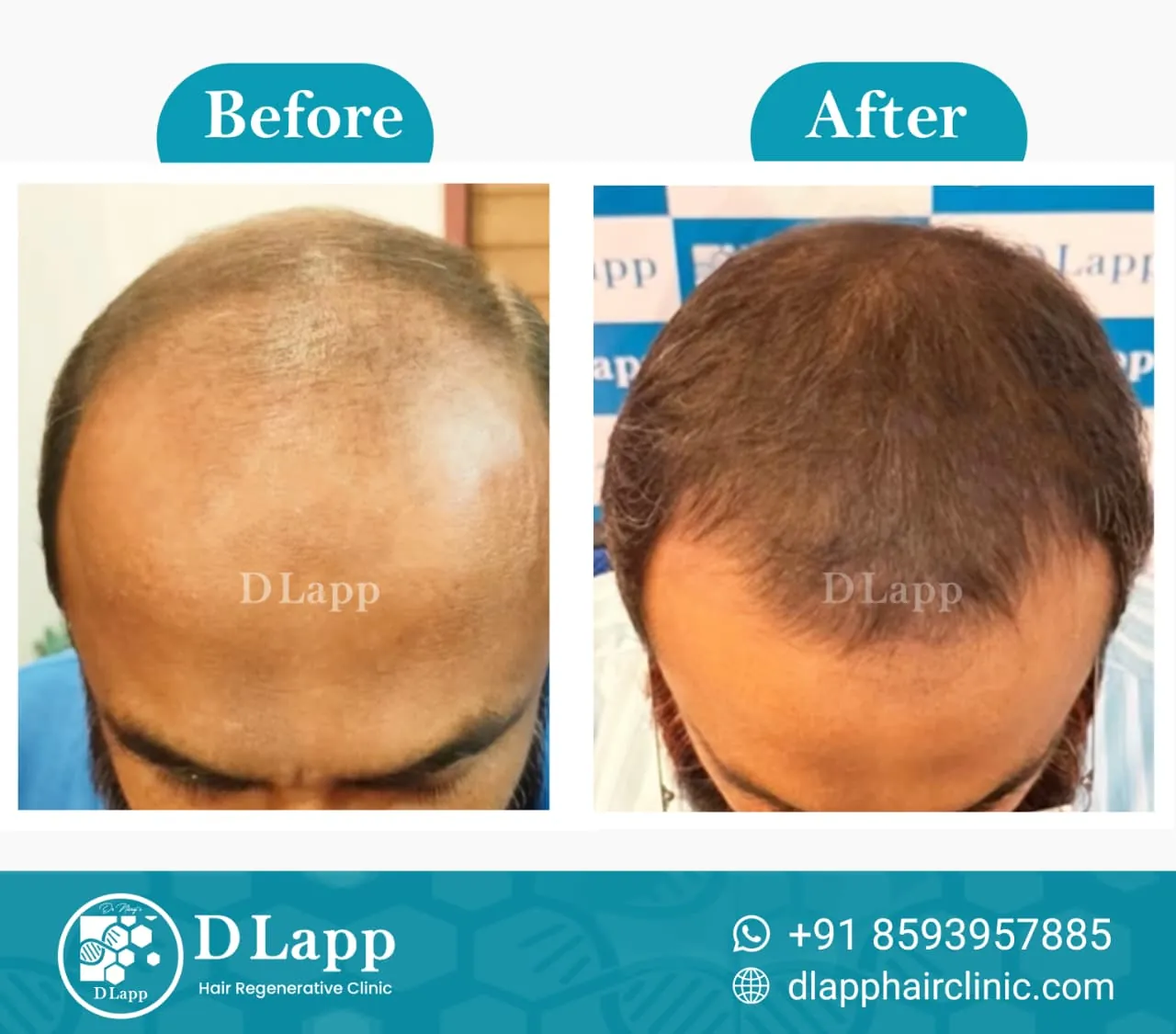 Hair Stem Cell Activation