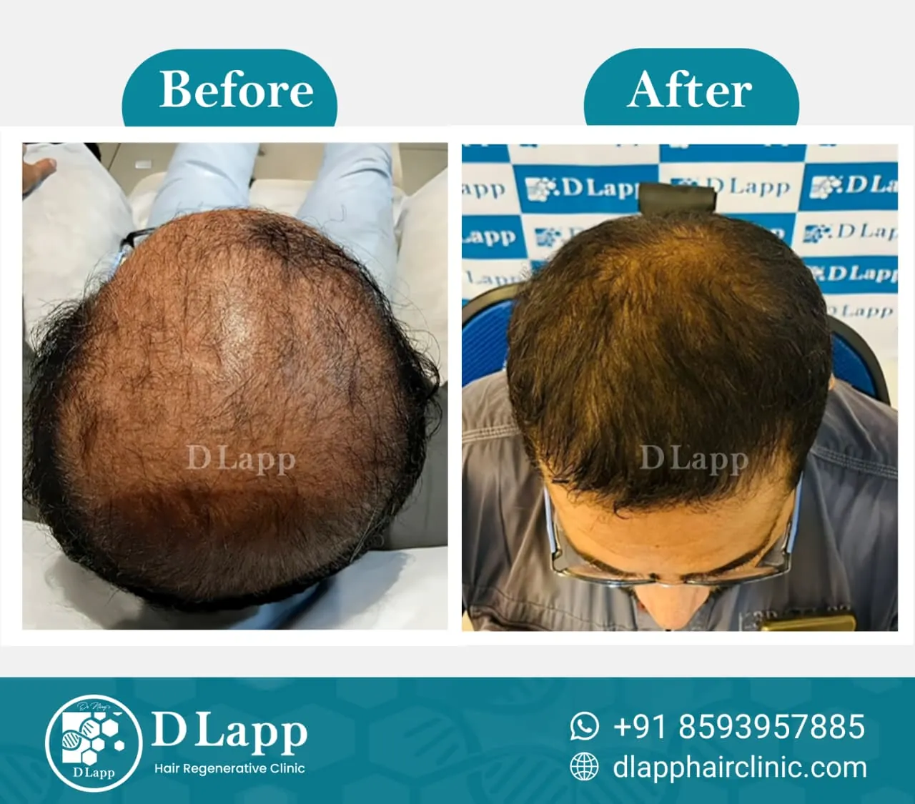 Hair Stem Cell Activation