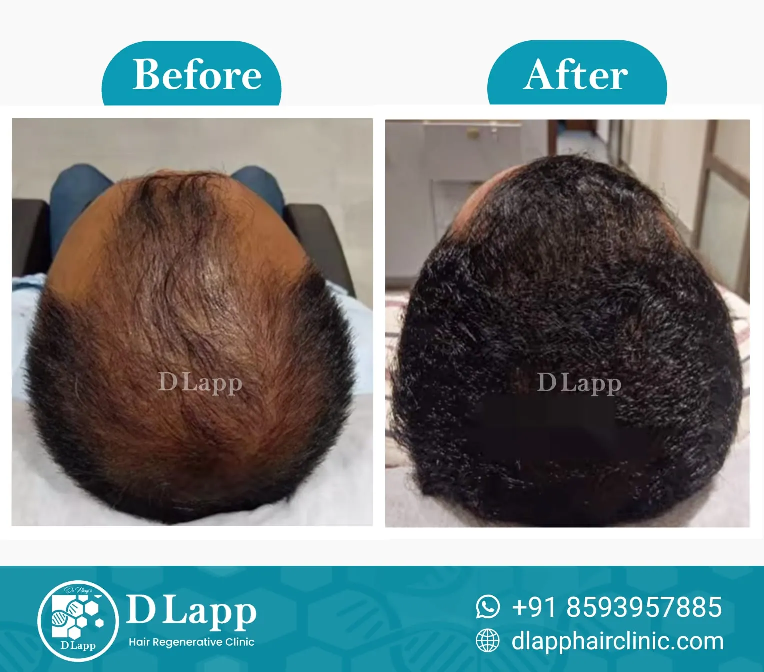 Hair Stem Cell Activation
