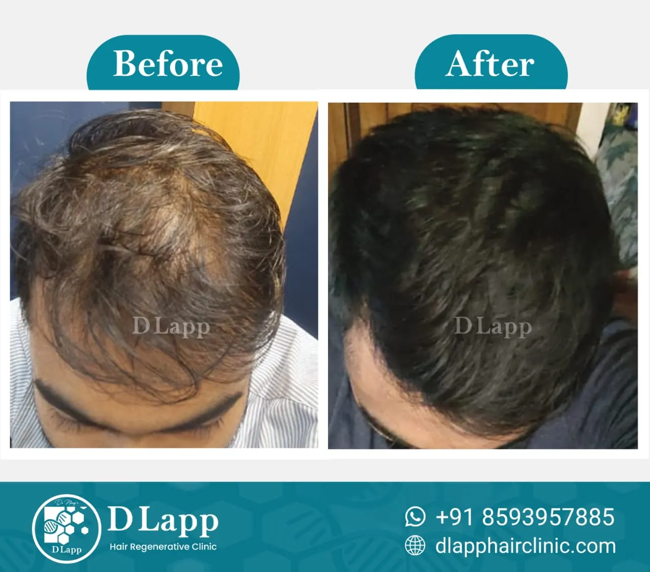 Hair Stem Cell Activation