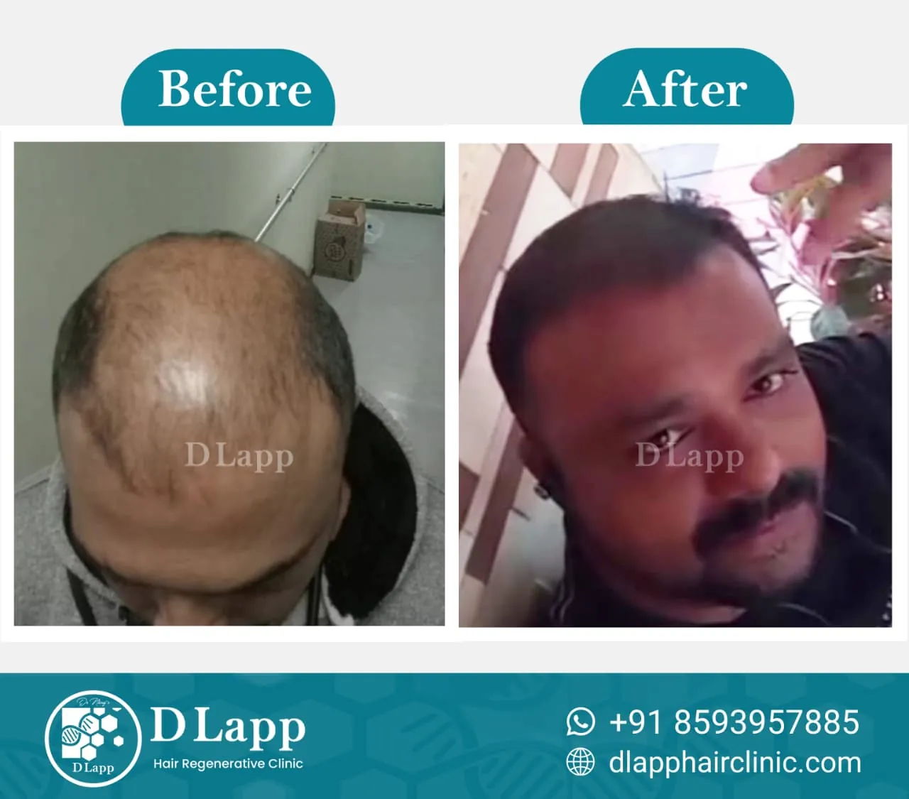 Hair Stem Cell Activation
