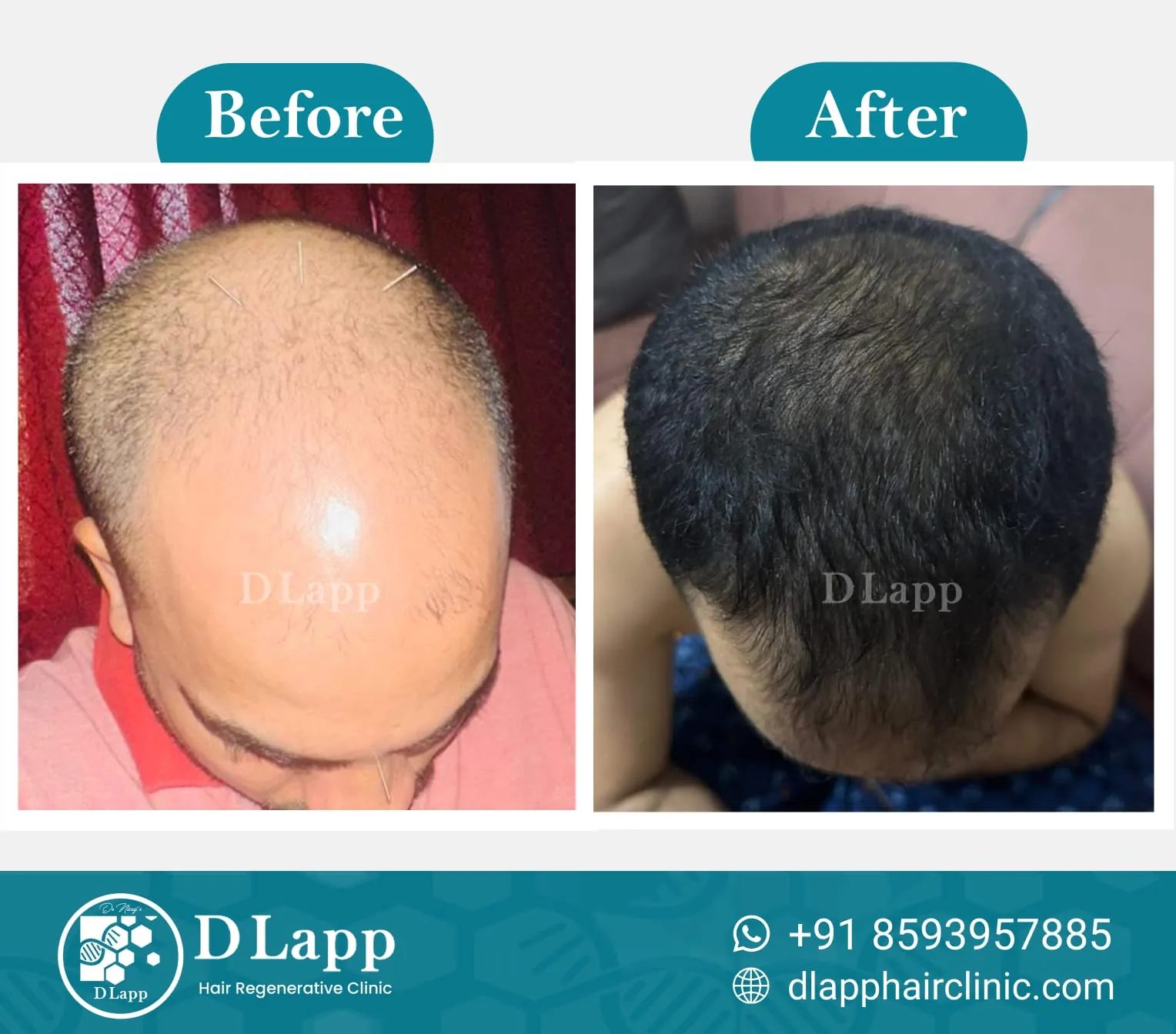 Hair Stem Cell Activation