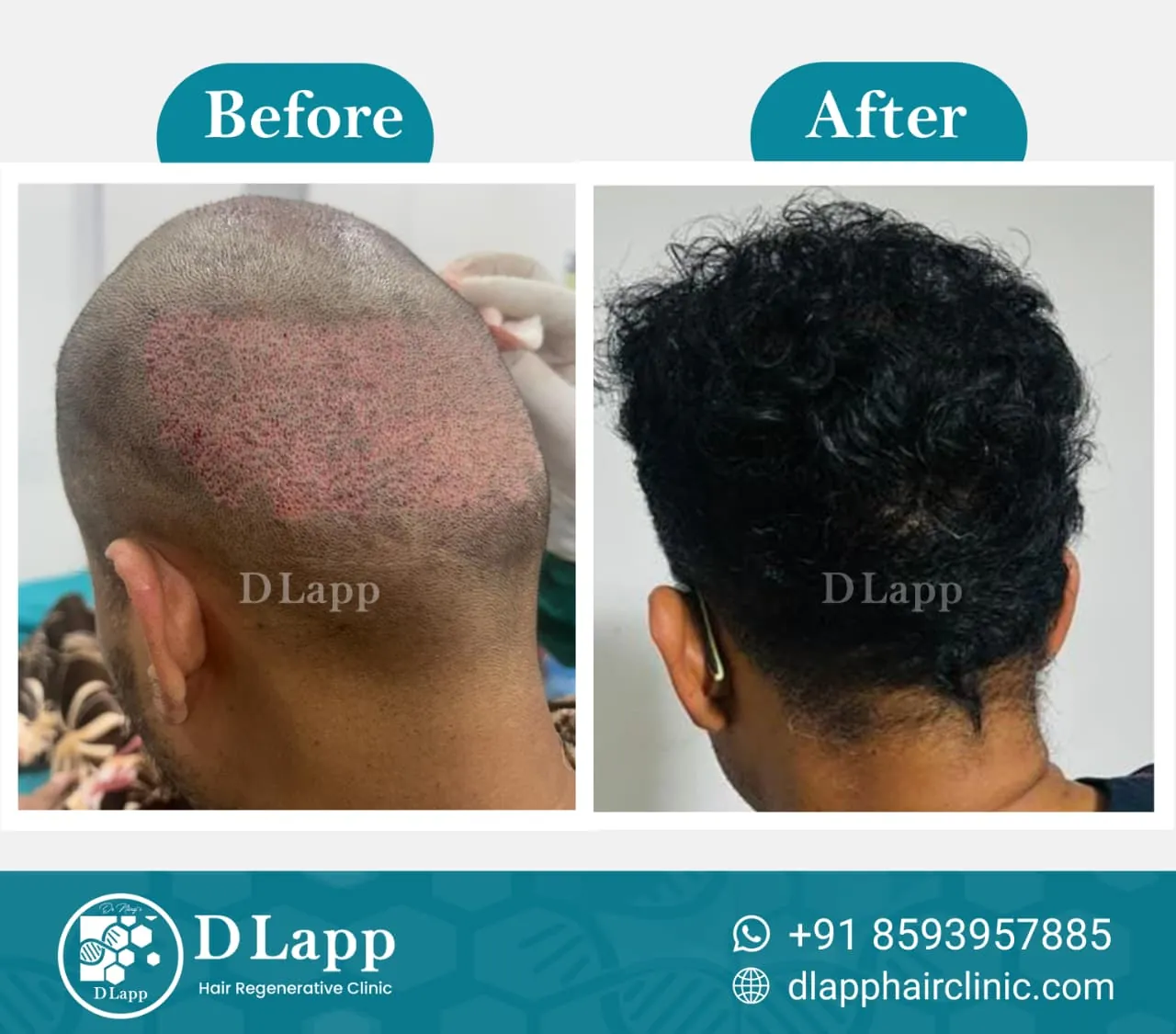 Hair Stem Cell Activation