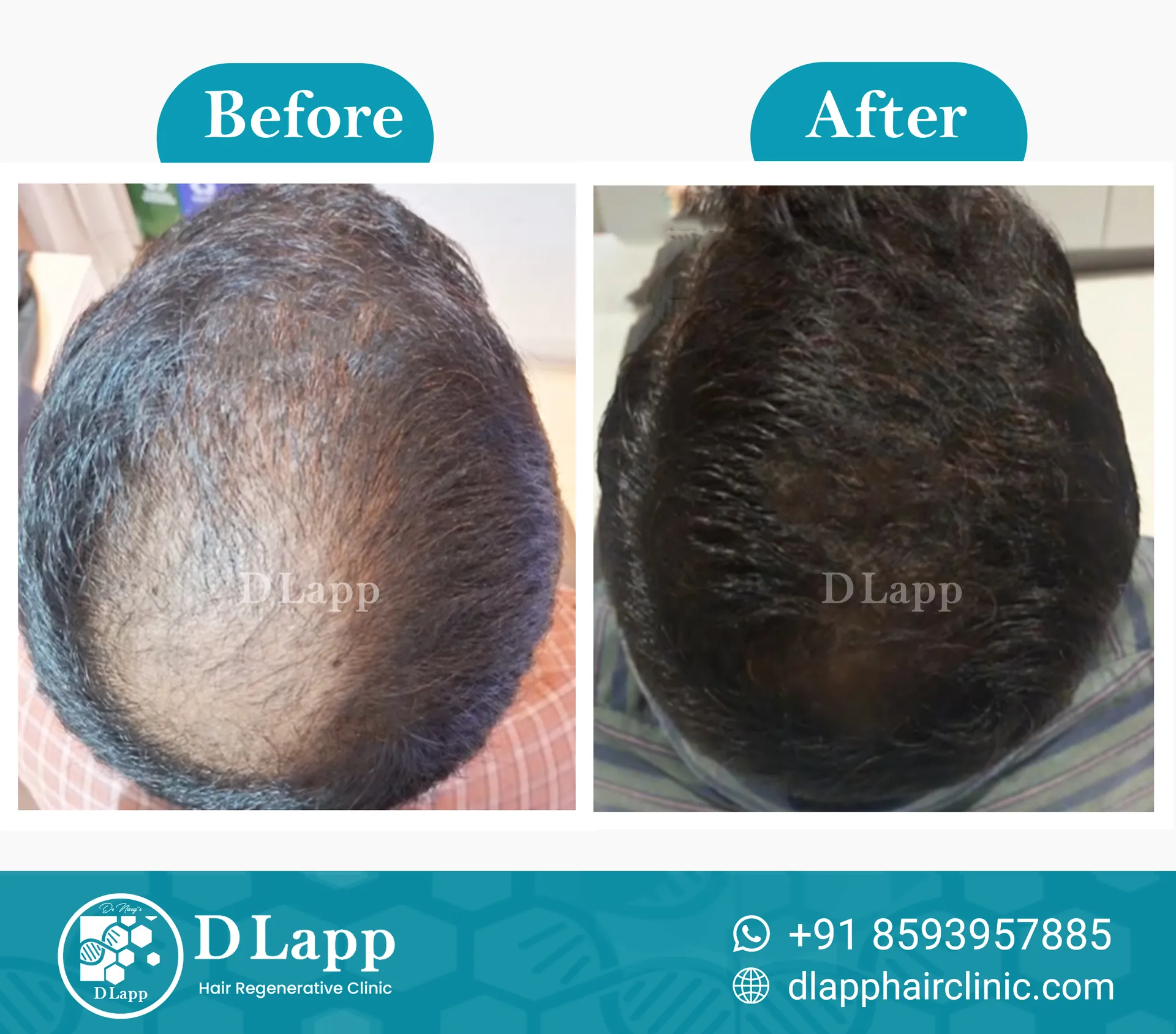 Hair Stem Cell Activation