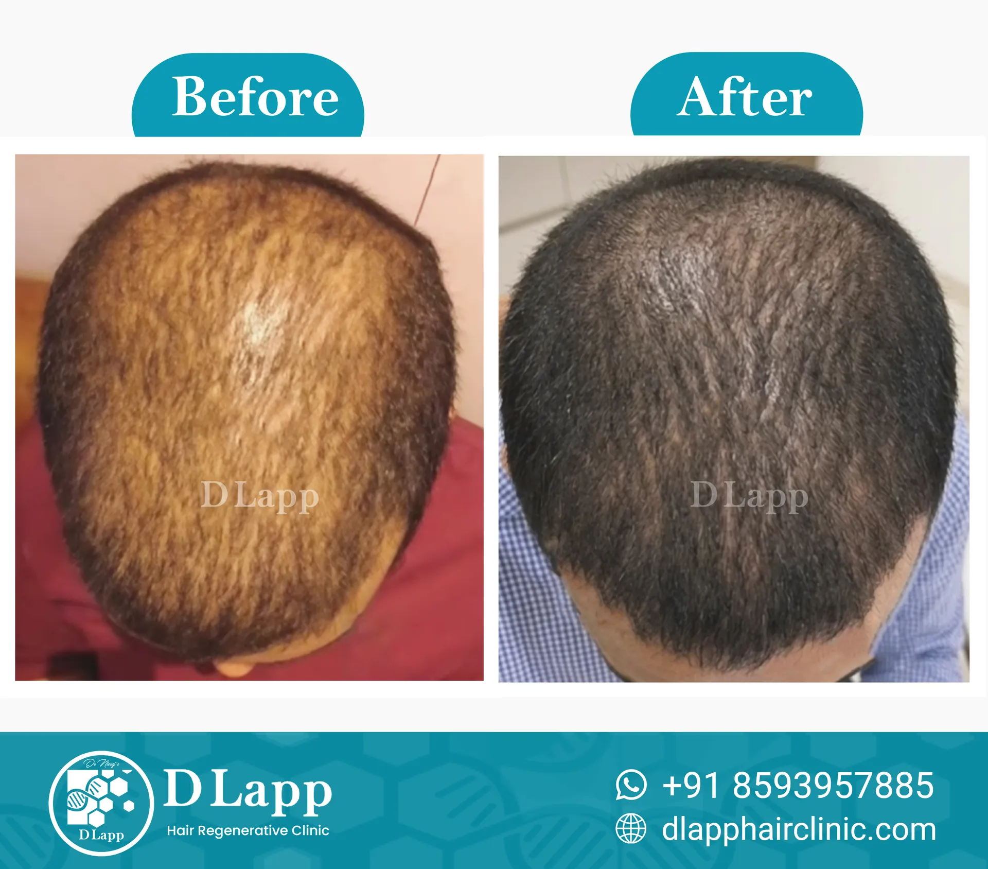 Hair Stem Cell Activation