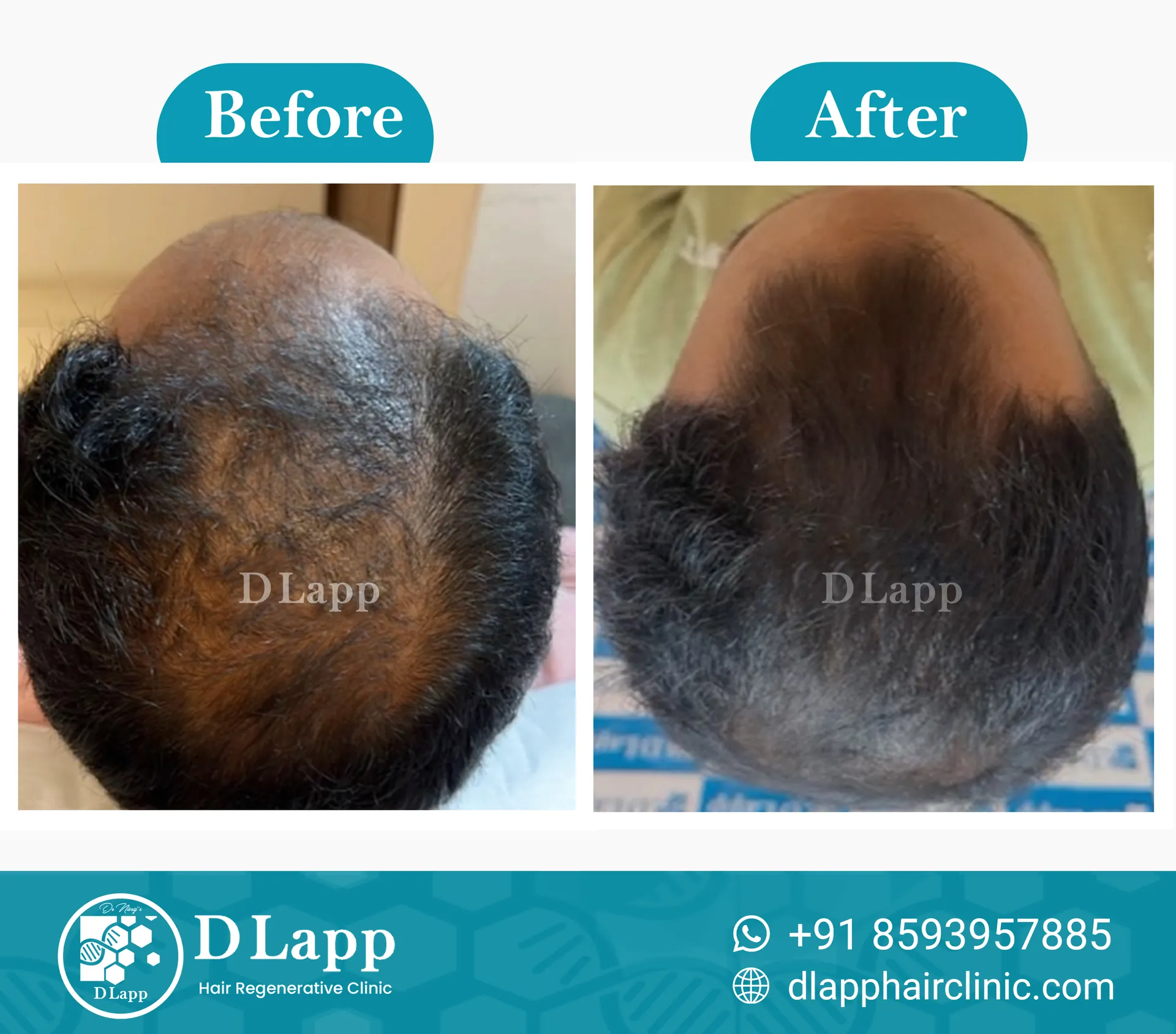 Hair Stem Cell Activation
