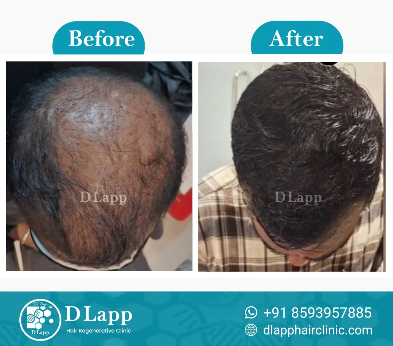 Hair Stem Cell Activation