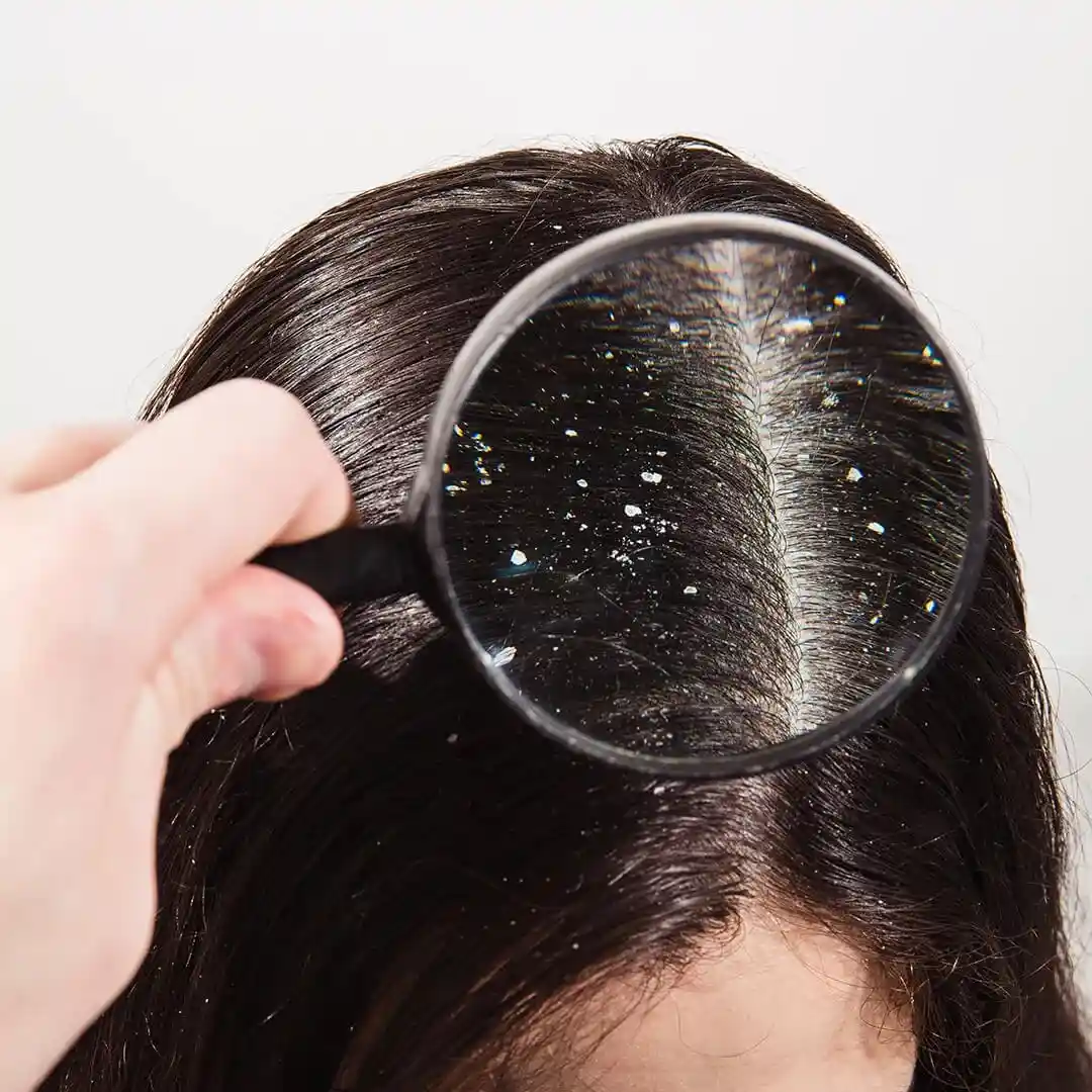 Dandruff and Seborrheic Dermatitis Treatment